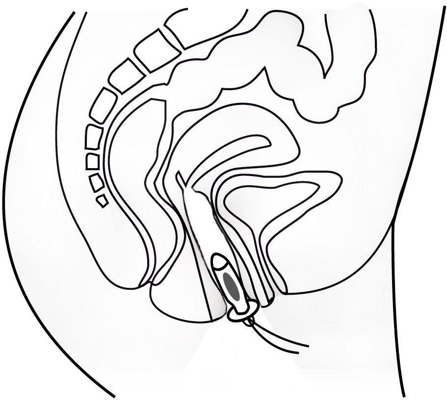 promed Bekkenbodemtrainer IT-6 Incontinentie-therapieapparaat