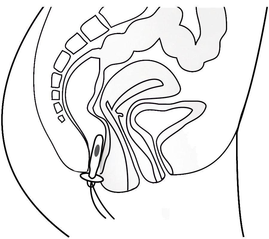 promed Bekkenbodemtrainer IT-6 Incontinentie-therapieapparaat