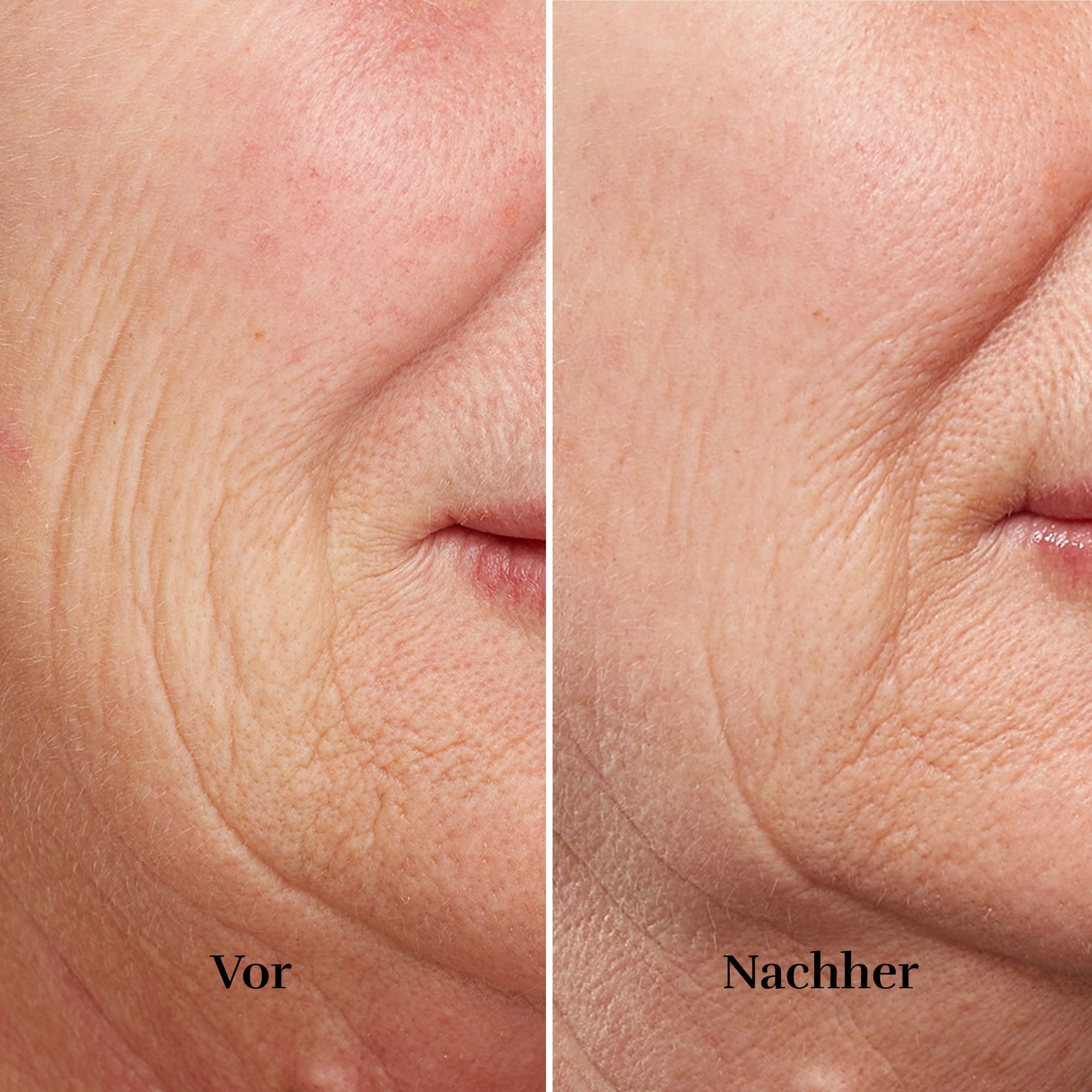 Silk'n Anti-aging-apparaat FaceTite Revive