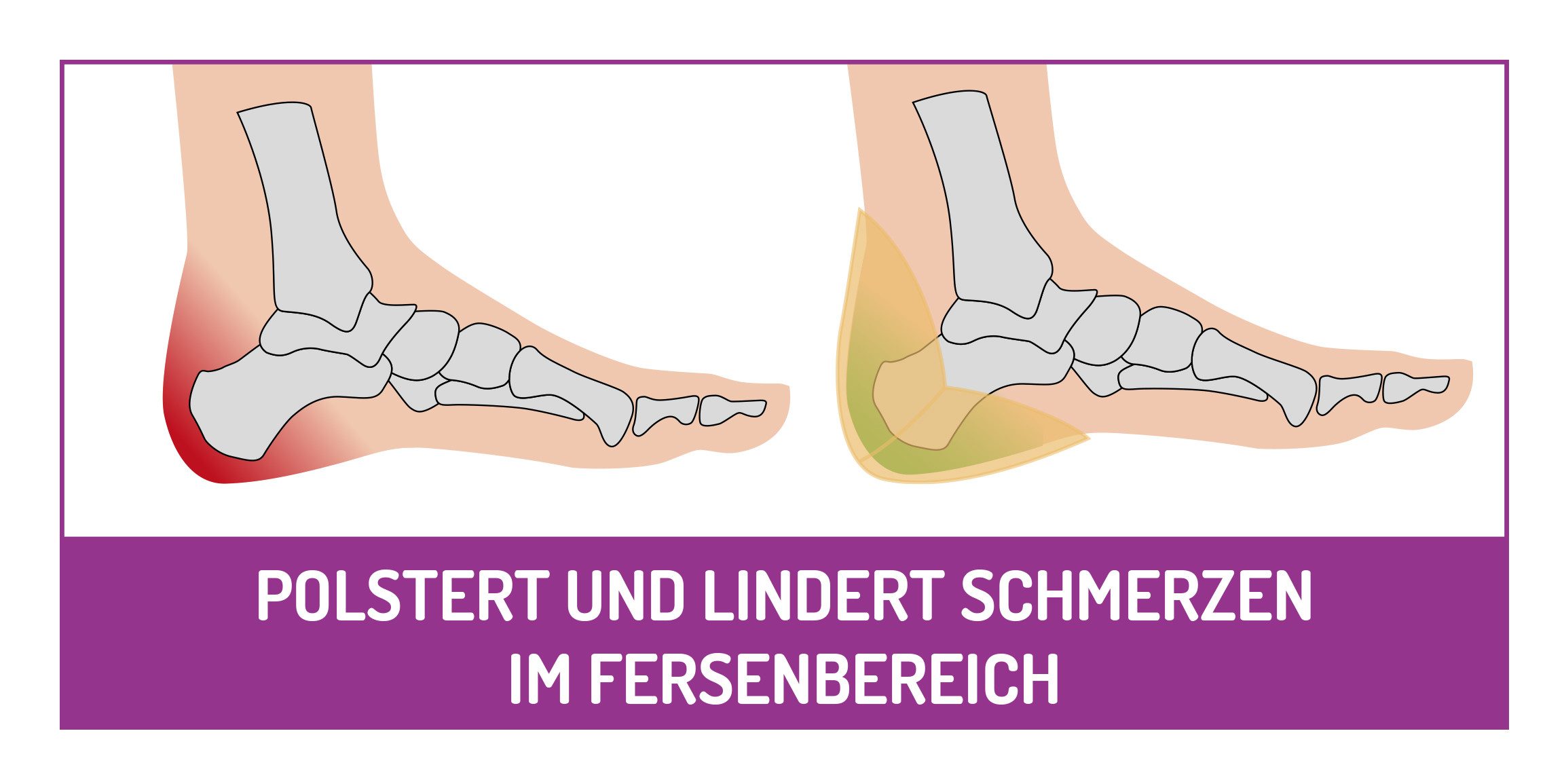 Fußgut Hallux-band Individueel met zacht gel-voorvoetkussen, eenvoudig aan te trekken