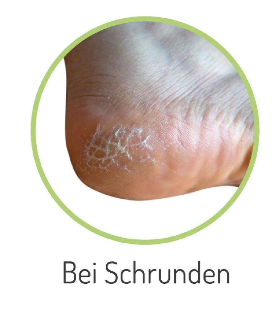 Fußgut Hallux-band Individueel met zacht gel-voorvoetkussen, eenvoudig aan te trekken