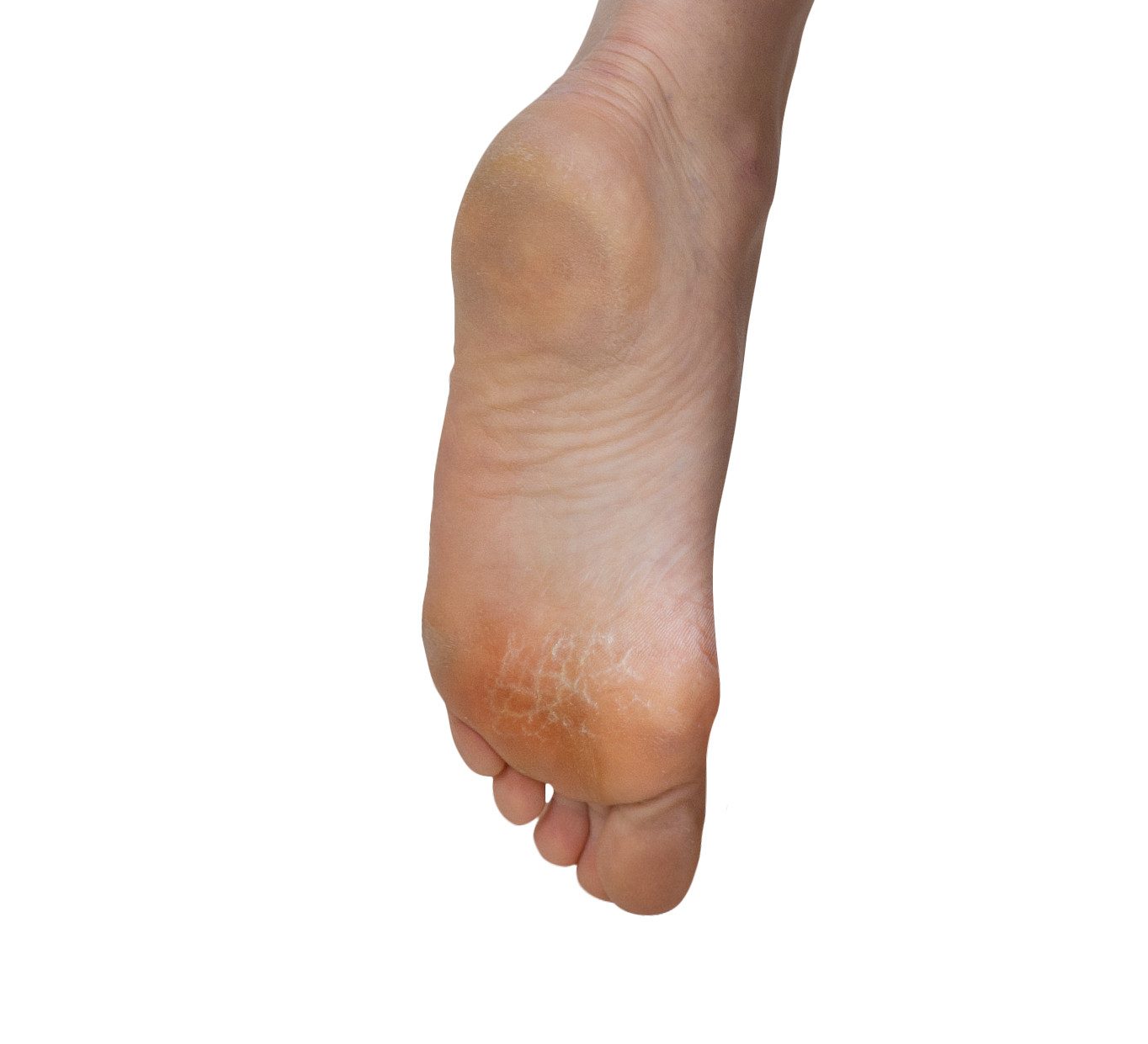 Fußgut Gelkussentje voor de bal van de voet Voorvoet balenkussen supersoft Optimale drukverdeling, voorvoetkussen, beschermt tegen wrijving en druk (set, 4-delig)