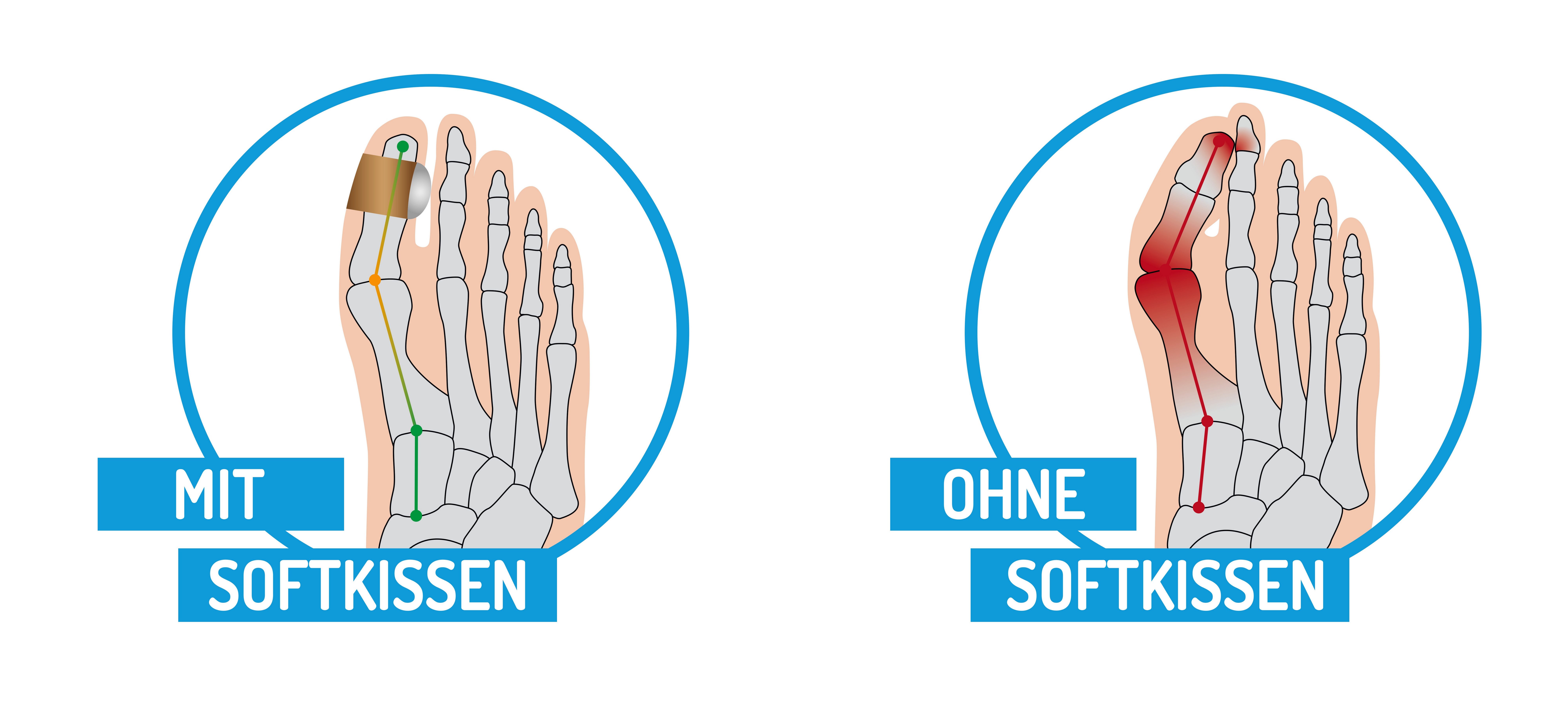 Fußgut Hallux-band Zacht kussen met fixeerband, voorkomt wrijving Drukverlichting bij eelt, likdoorns, verlichting hallux valgus